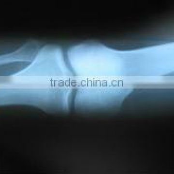 single film led medical film medical x-ray film